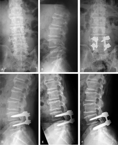Figure 1. A 67-year-old man. Preoperatively, anteroposterior (A) and lateral (B) views showing degenerative spondylo-listhesis at L4/L5.Two years postoperatively, anteroposterior (C), lateral (D), flexion (E) and extension (F) views showed stable implants, solid fusion, and no motion in flexion and extension on stress radiographs.
