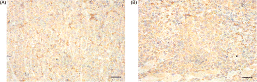 Figure 3. The vascular endothelial growth factor (VEGF) expression of tumor tissues at 24 h after treating with magnetic field stained by immunohistochemical method. (A) injected with physiological saline; (B) injected with magnetic fluid. (The scale bars represent 50 µm. VEGF was distributing in cytoplasm and intercellular substance. The intensity in B seemed higher than in A.)