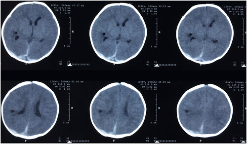 Figure 2. Postoperative head CT scan.
