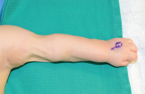Figure 1. The 7-month-old boy has persistent flail arm after constriction band release with Z-plasty at 3 months of age at an outside hospital. The arm had limb length discrepancy but did show evidence of tone to hand and forearm.