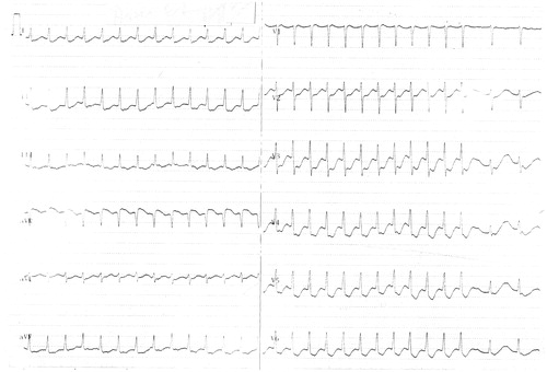 Figure 1. Electrocardiography of the patient on admission.