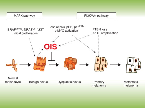 Figure 1. Genetic alterations leading to bypass of oncogene-induced senescence (OIS) and transformation of melanocytes.
