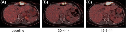 Figure 2. (A) Tumor at baseline just before the start of brentuximab treatment. (B) Shows response to brentuximab with regression of tumor burden. (C) Shows progression under brentuximab treatment.