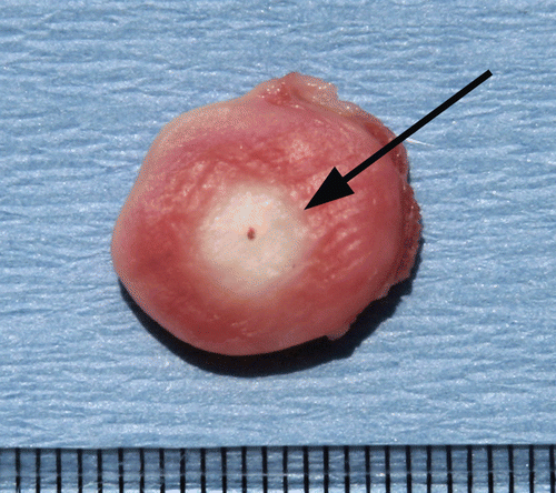 Figure 2. Cross section of stained ablated tumor. This figure demonstrates a cross section of RF ablated tumor stained with TTC. Sharp demarcation is noted at the margin (arrow) between the white, ablated tissue and the unablated surrounding tumor tissue stained pink. Central dot in the white coagulation denotes the original position of the RF electrode.