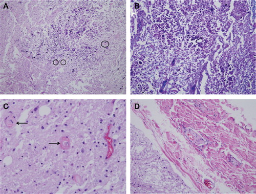 Figure 3. Histopathology of spinal cord showing spheroids (A), demyelination (B), hyalinization of small vessels (C) and significant damage to adjacent skeletal muscle (D), all indicating radiation effects.