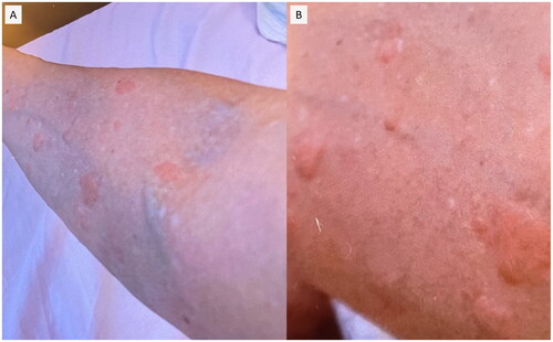 Figure 2. On both upper extremities, eruptions of 0.5–2 cm were noted that faded within 12–24 h.