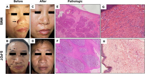 Figure 2. Clinical and pathology pictures in MMS and S-PDT groups. (A,B) Clinical picture with one lesion before treatment and 12 mouth follow-up in MMS group. (C,D) Clinical picture with four lesions before treatment and 12 mouth follow-up in S-PDT group. (E,F) Pathology before treatment in both groups shows basal cell carcinomas with basal cell-like cell hyperplasia, cytoplasm, deep staining of the nucleus, nucleus, disordered arrangement (hematoxylin–eosin stain, original magnification ×100). (G) Pathological biopsies after 1 year of follow-up in MMS group and show scar tissue. (F) Pathological biopsies after 2 years of follow-up in S-PDT group and show scar tissue and no recurrent pathological features.