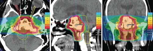 Figure 3. Typical treatment plan for a patient with a skull base chordoma treated up to a total dose of 66 Gy E with carbon ion radiotherapy.