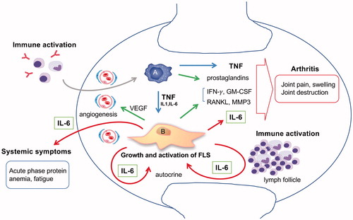 Figure 1 The pathogenic role of IL-6 in RA synovitis. There are the two main cellular components in the synovium. Type A synoviocytes are bone marrow derived macrophage-like cells. Type B synoviocytes are residential fibroblast like cells also known as FLS. In the rheumatoid synovium, FLS mainly contributes to arthritis by producing IL-6, RANKL, MMP3, GM-CSF, IFN-γ, and VEGF. TNF and IL-6 stimulate FLS autocrinally and induce tumor-like proliferation of FLS. Local arthritic symptoms are generated by the collaboration of IL-6 with TNF- and FLS-derived cytokines. Systemic symptoms are caused by IL-6. IL-6 also contributes to immune activation and leads to synovitis, resulting in a vicious circle.