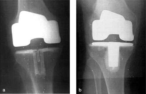 Figure 2. Standard anterior postoperative radiographs of the a) all-polyethylene completely, cemented (APCC), and b) metal-backed, completely cemented (MBCC) tibial components.