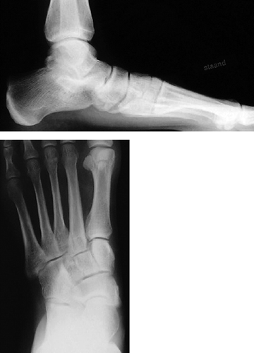 Figure 1. Patient with an acquired flatfoot before calcaneo-cuboid distraction arthrodesis.