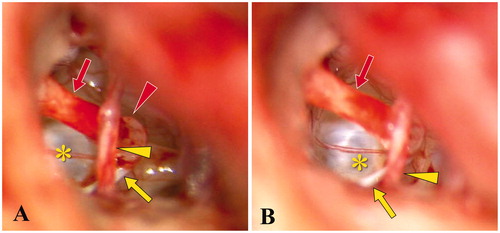 Figure 4. Schema and intraoperative microscopic view of the middle ear in case 2. (A, B) The post-tympanotomy images show the inferiorly located stapes superstructure attached to the promontory. Red arrow: long process of incus, red arrowhead: head of stapes, yellow asterisk: oval window, yellow arrow: tendon of stapedius, and yellow arrowhead: chorda tympani nerve