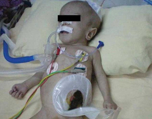 Figure 1. Patient at 6 months of age, with respiratory failure, in intensive care unit.