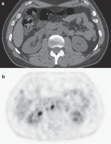 Figure 1. Comparison between normal abdominal CT (a) and PET/CT which demonstrates abnormal uptake in paraaortic lymph nodes (b).