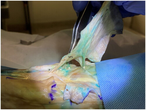 Figure 3. lateral side view of right foot shows colorized perforating branches of the dorsalis pedis artery under the pedicle of the flap (white asterisk). SPN, superficial peroneal nerve; P, pedicle of flap.
