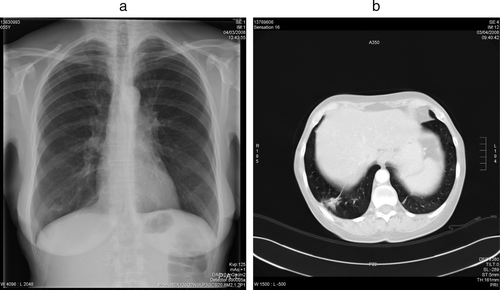 Figure 3.  Tumor regression documented by chest radiograph 1 month (a, 04-03-3008) and confirmed by CT scan 10 weeks after resuming sunitinib (b) 03-04-2008).
