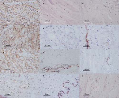 Immunohistochemical expression of α-SMA (a, b, c); Cx26 (d, e, f); Cx43 (g, h, i), and Cx30 (j, k, l) in tissue sections from the involutional phase of DD (a, d, g, j); in tissue sections from the residual phase of DD (b, e, h, k), and in tissue sections from controls (patients with carpal tunnel syndrome) (c, f, i, l) (magnification 400×).