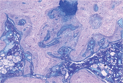 Figure 6. Histological features of the fracture site at postoperative week 3 (Giemsa stain, 50× magnification). The cell proliferation had finished. Most of the new-formed trabeculae had transformed into lamellar structures. The newly formed bone tissue could be distinguished from the original bone tissue due to the cell density, the cell size, and the orientation of the matrix.
