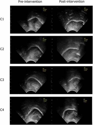 Figure 2. Ultrasound images of children 1–4 labelled as C1–C4. /r/-sounds from the pre- and post-intervention measurements. Mid-sagittal view, the tip of the tongue on the right.