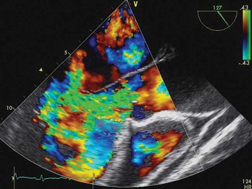 Figure 4. Severe aortic regurgitation and pericardial effusion was seen in transesophageal echocardiogram.