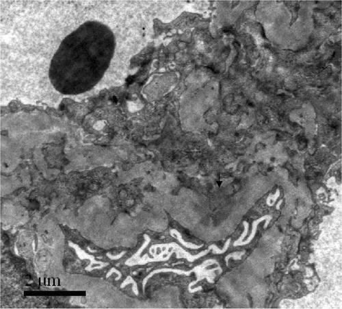 Figure 5. Electron-dense deposits in mesangium were seen by electron microscopy (arrowheads).