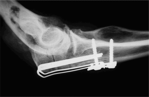 Figure 2. Olecranon fracture in cadaveric bone. The fracture is fixed with the olecranon sled, washer with compression screw and fixation screw.