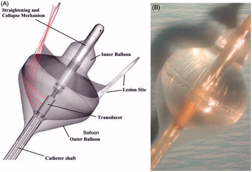 Figure 3. Schematic (A) and prototype (B) of a tip-firing cardiac ablation catheter designed for treating atrial fibrillation by ablating tissue around the pulmonary vein circumference. Here, acoustic energy generated by the cylindrical transducer element is reflected by the air-water interface created by the outer air-filled balloon and the inner water-filled coupling balloon [Citation90].