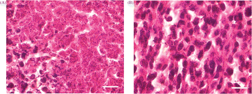 Figure 1. (A) Histological analysis of tumor tissue after the alternating treatment. Immediately after the alternating cooling and heating treatment, the tumor debris was taken for H&E stain; (B) Histological analysis of tumor tissue without any treatment. The sections were viewed with 100× oil objective. (Scale bar, 10 µm) It showed that although the thermophysical treatment induced necrosis, there were still viable tumor cells remaining.