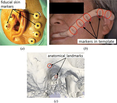 Figure 6 Fiducial markers for registration; (a) skin markers, (b) template, and (c) anatomical landmarks on the temporal bone (color figure available online).