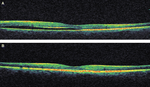 FIGURE 2  (A) Baseline horizontal OCT scan shows serous retinal detachment with a few irregularities on outer neurosensory retina related to central serous chorioretinopathy (CSC). (B) After stopping the therapy, significant resolution of submacular fluid was observed in same section of OCT scan with marked decrease of foveal thickening from 345 to 198 μm and visual acuity improved to 20/20.