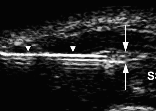 Figure 1A. Ultrasonographic image showing the supraspinatus tendon (SSP) in the longitudinal plane. The advancing needle (arrows) under real-time ultrasound guidance has entered the subacromial-subdeltoid bursa (between arrowheads). D: deltoid muscle; H: humeral head.