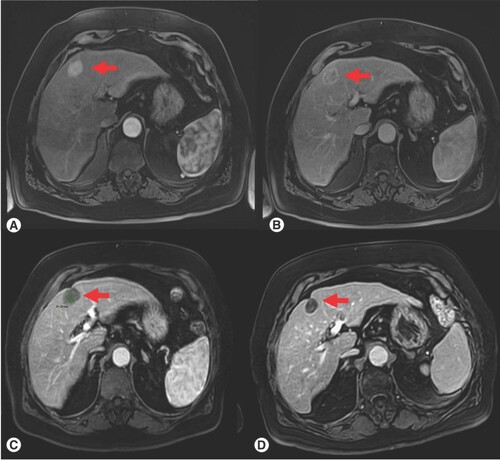 Figure 4. Tumor response after TATO microwave ablation. (A) Pretreatment, arterial phase on dynamic MRI, (B) Pretreatment, portal phase on dynamic MRI; (C) Post-treatment, 3-month follow-up; (D) Post-treatment, 6-month follow-up, there is a clear progressive reduction in size of the lesion as well as absence of contrast enhancement. Red arrow indicates the target liver lesion.