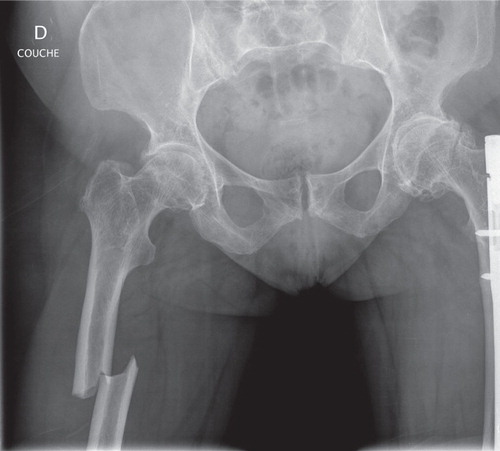 Figure. The atypical fracture of the right femur.