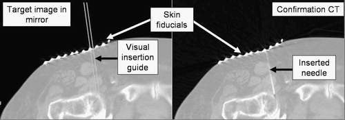 Figure 12. Target image (left) and confirmation CT image (right) in a hip arthrography.
