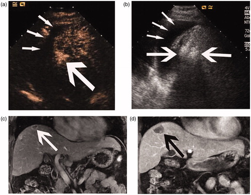 Figure 2. Images of a 58-year-old man with a 1.8-cm HCC treated by percutaneous MWA with artificial pleural effusion. (a) Contrast-enhanced sonogram showing the hyper-enhancing neoplasm (large arrow) clearly with the artificial pleural effusion (thin arrows) as acoustic window. (b) Sonogram showing the procedure of microwave ablation. Note microwave antenna in index tumour (large arrow) and artificial pleural effusion (thin arrows). (c) Coronal preablation contrast-enhanced MR image shows the hypointense neoplasm in delayed phase (arrows). (d) Coronal contrast-enhanced MR image 1 month after MWA shows the ablation zone (arrows).