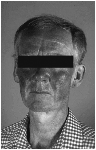 Figure 4. The typical flush, the clinical hallmark of the carcinoid syndrome, begins suddenly and lasts 20 to 30 seconds. It primarily involves the face, neck, and upper chest. (Courtesy of Prof. Dr Arnold, Marburg, Germany)