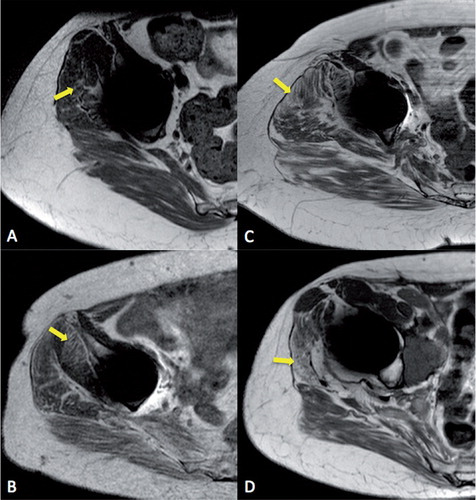 Figure 2. MRI demonstrating increasing grades of muscle atrophy in MOM hip patients. A. Grade 1. B. Grade 2. C. Grade 3. D. Grade 4. Areas of significant atrophy are highlighted with arrows.