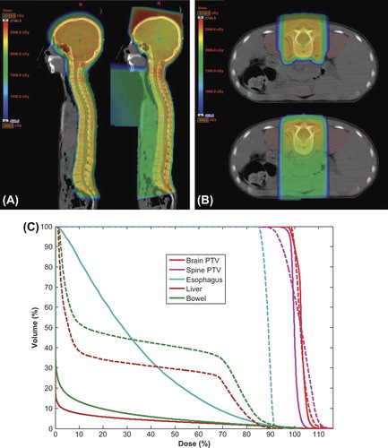 Figure 1. Representative examples of dose distribution for the craniospinal irradiation method. (A) Sagittal view (left: proton beam therapy; right: photon beam therapy). (B) Axial view (top: proton beam therapy, bottom: photon beam therapy). (C) Dose-volume histograms for the brain and spinal planning target volumes, and of specific tissues of interest (solid line: proton beam therapy, dashed line: photon beam therapy). PTV, planning target volume.