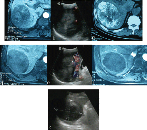Figure 1. A 12 cm HCC tumor occupying segment six of the right lobe of the liver in a 53-years-old patient underwent one course of TACE and three sessions of microwave ablation for HCC. Compared with tumor size before ablation, an obvious shrinkage and absences of contrast enhancement within the treated region was observed in the lesion treated with TACE plus microwave ablation. (a, b) before TACE; (c) 3 weeks after TACE and just before microwave ablation; (d, e) 3 weeks after TACE, just before ablation, tumor blood supply was reduced, but contrast enhancement still remained in some areas within the tumor; (f, g) After the microwave ablation session, no evidence of contrast enhancement was observed in the treated HCC, the tumor became completely necrotic.