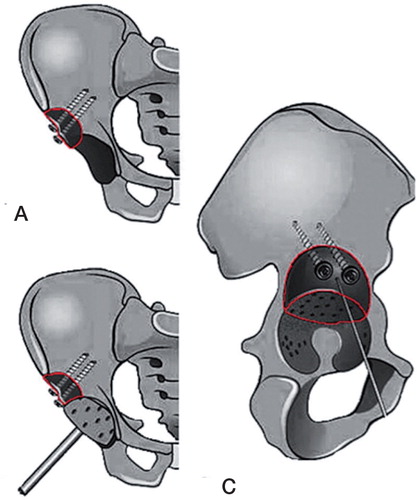 Figure 4. Technique of acetabular solid grafting: (A) Graft is ﬁxated with two cancellous lag screws with its sclerotic convex side toward the defect as an inlay graft. (B) Reaming of the graft to prepare for a cemented socket. (C) Final situation before cementation and insertion of the acetabular component.
