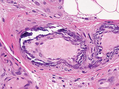Figure 2. Histology demonstrating the extensive medial calcification of the small-sized arteries in the subcutaneous tissue, which is typical of calcific uremic arteriolopathy (CUA).