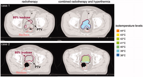 Figure 4. Example of a treatment planning with dose distributions for radiotherapy alone and equivalent dose distributions for combined radiotherapy and hyperthermia for two prostate cancer patients with a low (case 1) and a high median temperature (case 2) [Citation23]. The 95% isodose level gives better tumour coverage for RT + HT in both cases, particularly in the region close to the rectum.