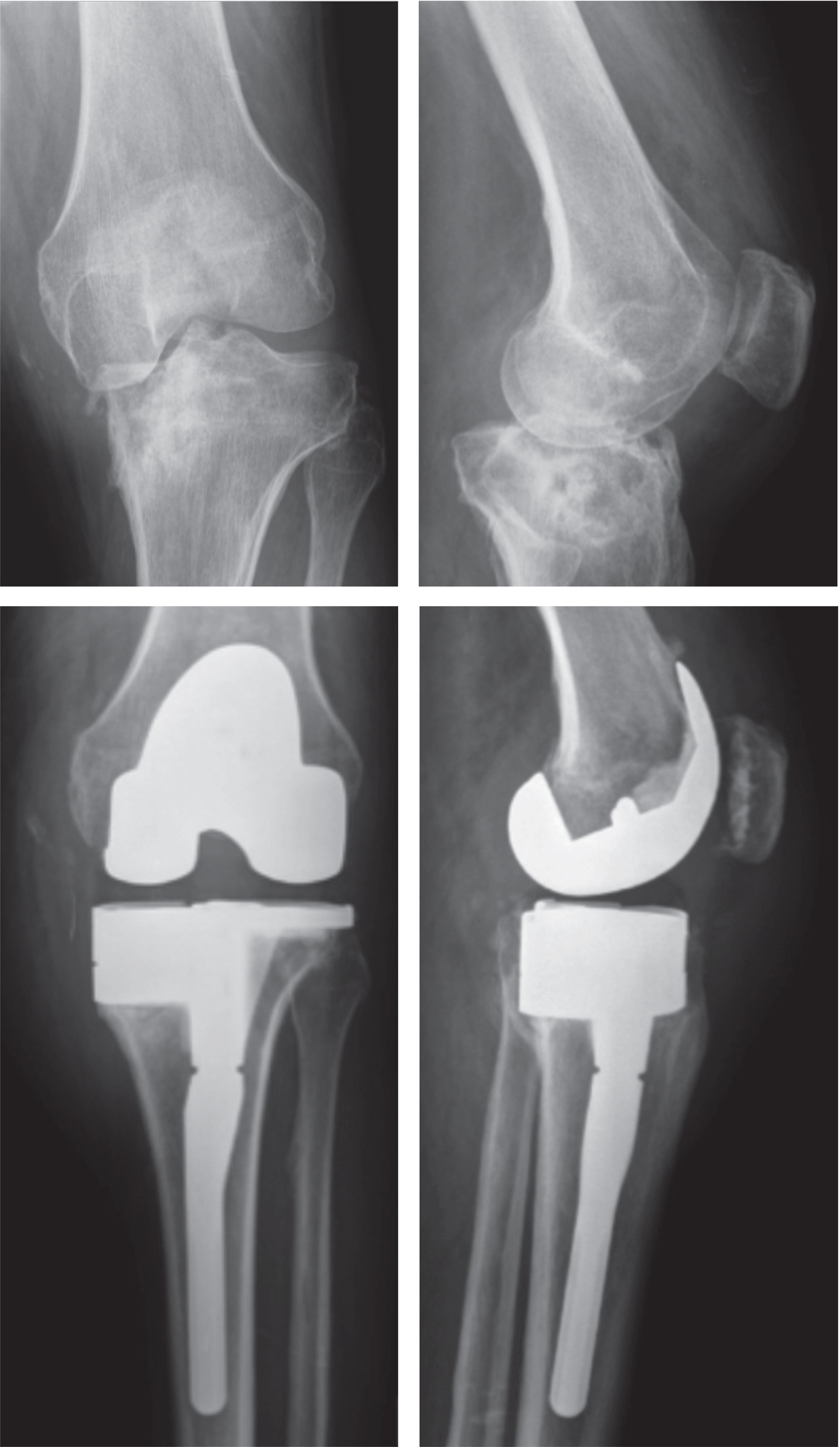 Figure 1. A typical case: a 60-year-old active man with a history of fracture of the medial tibial plateau. TKA required use of stems and augments and a muscular flap. At 8 years, the patient is doing well but still has limitation of flexion at 105° and is limited during his activities of daily living. The implant is radiographically stable.