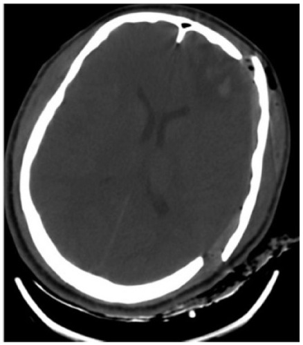 Figure 2 Left fronto-temporal decompressive craniotomy.