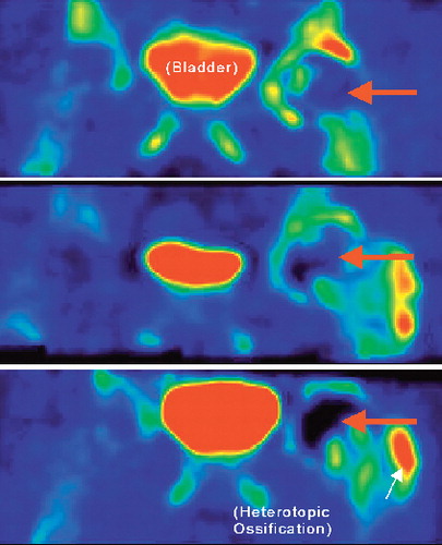 Figure 3. PET scans of osteonecrosis (red arrows). Top panel: 1 week; middle panel: 4 months; bottom panel: 1 year after surgery.