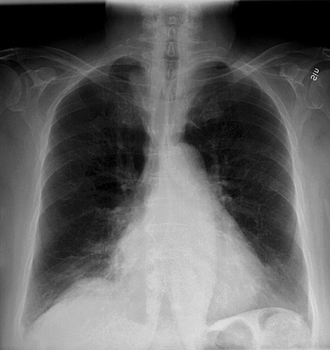 Figure 2.  X-ray of lungs February 2005 with complete regression of all metastatic lung lesions.