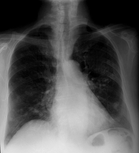 Figure 1.  Pulmonary x-ray at diagnoses October 1999 showing multiple lung metastases in both lungs.