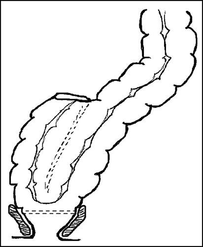 Figure 1.  The colonic J-pouch.