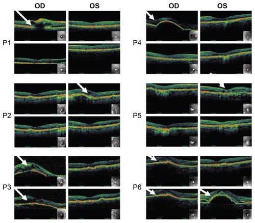 Figure 1 Optical coherence tomographic (OCT) images illustrating retinal thickness of each individual patient (P1–P6) before and after injections (18 weeks in between images).