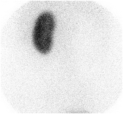 Figure 1. Tc99mDMSA scan shows solitary left kidney.